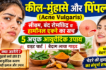 कील-मुंहासे और पिंपल्स के कारण, 5 आयुर्वेदिक उपाय और साफ त्वचा के टिप्स